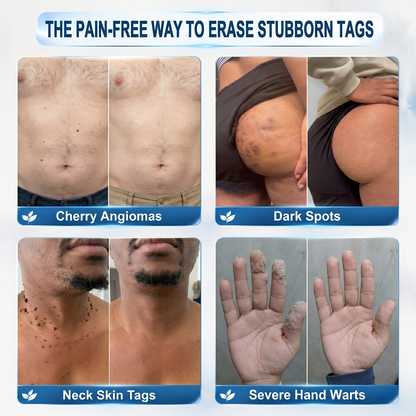 picdo skin tag remover