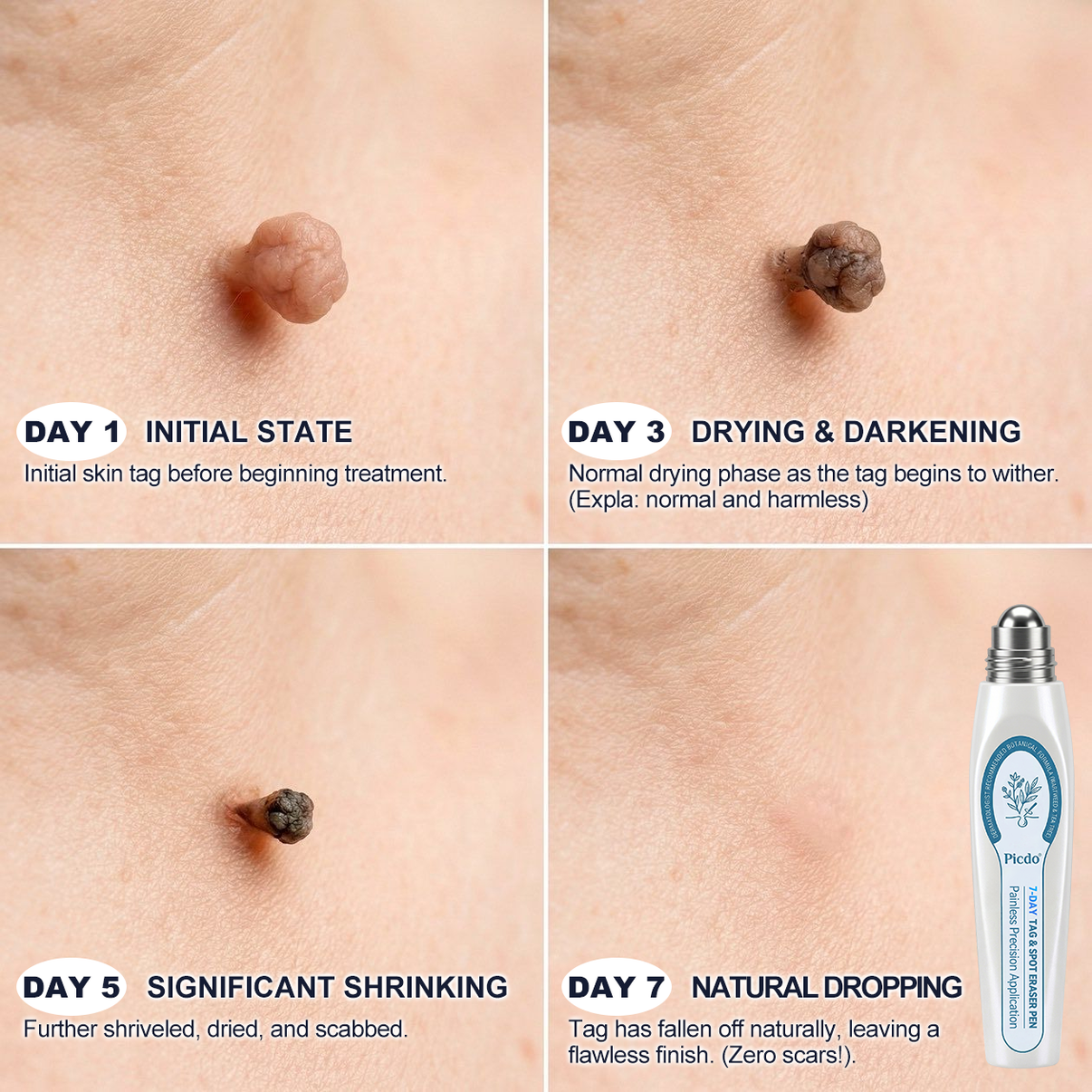 picdo skin tag remover