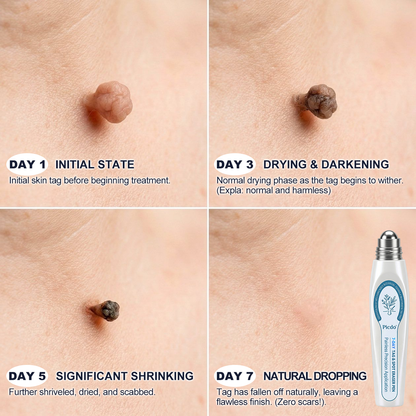 picdo skin tag remover
